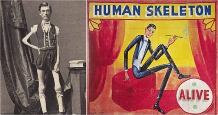 Isaac W. Sprague, The Living Skeleton Of Sideshow Fame